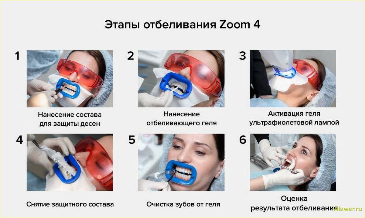 Отбеливание зубов в клинике Zoom