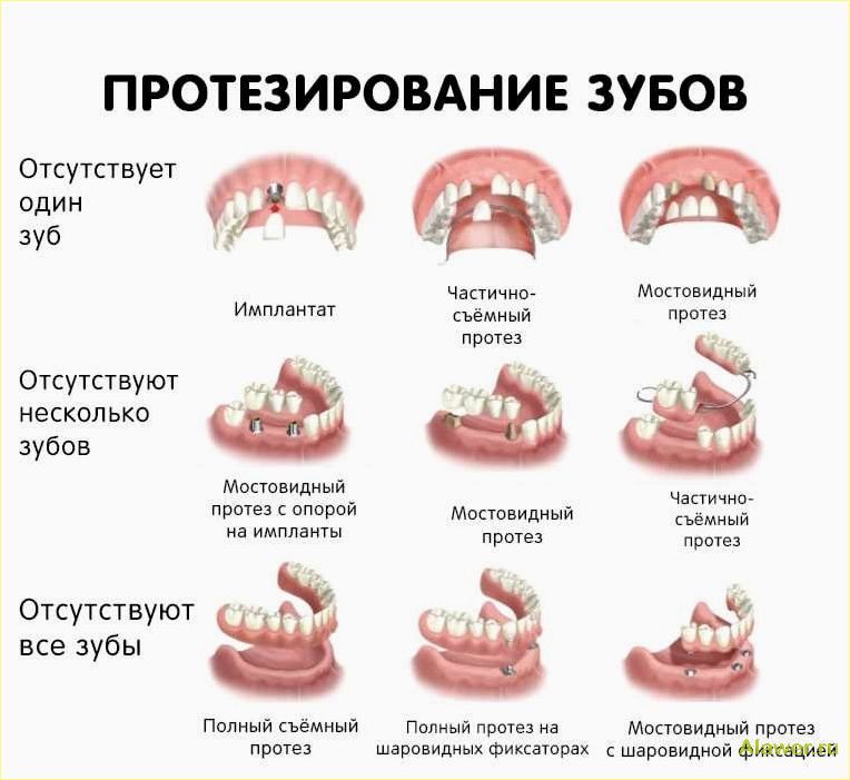 Протезирование зубов: все, что вам нужно знать