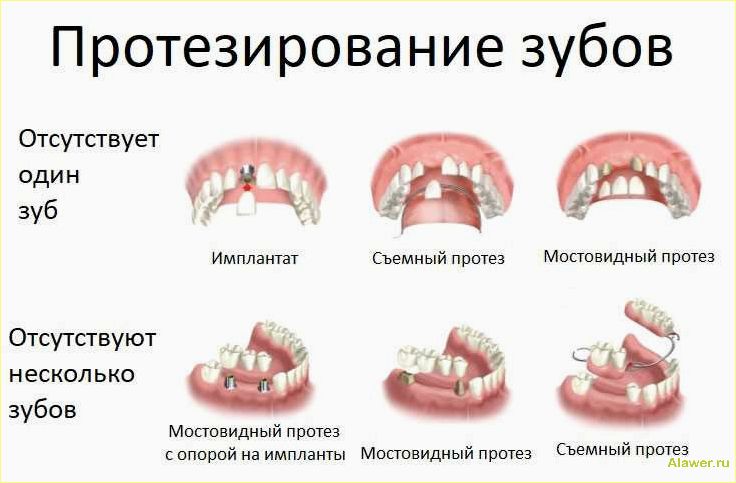 Протезирование зубов: все, что вам нужно знать